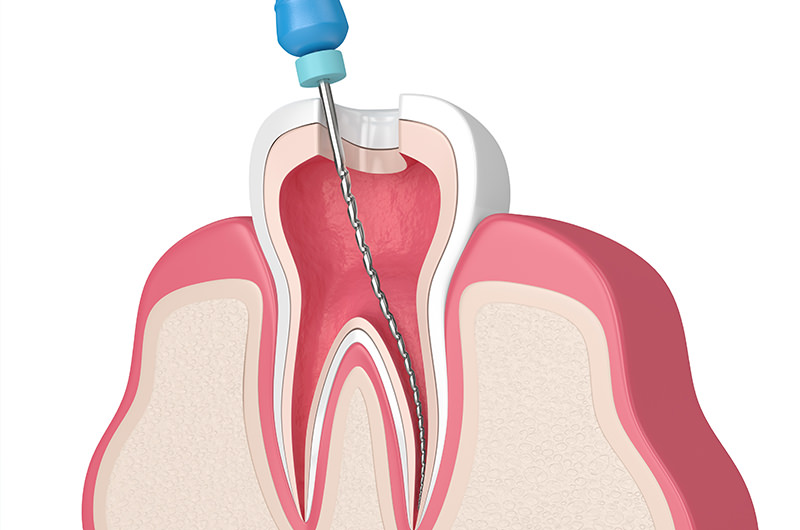 根管治療